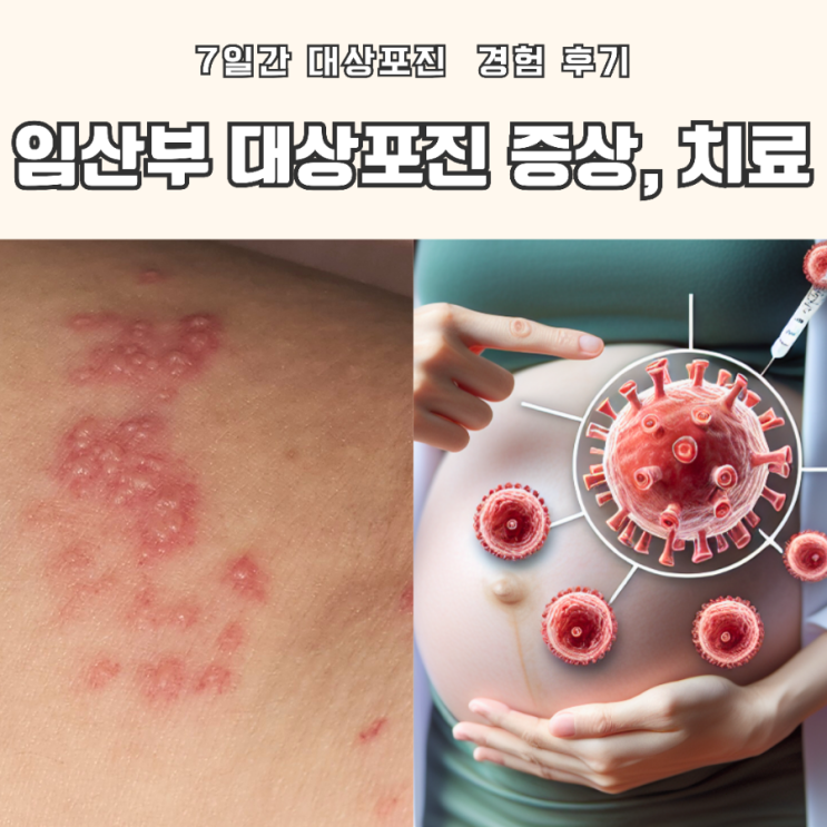  예비맘의 대상포진 투병기: 증상과 치료법