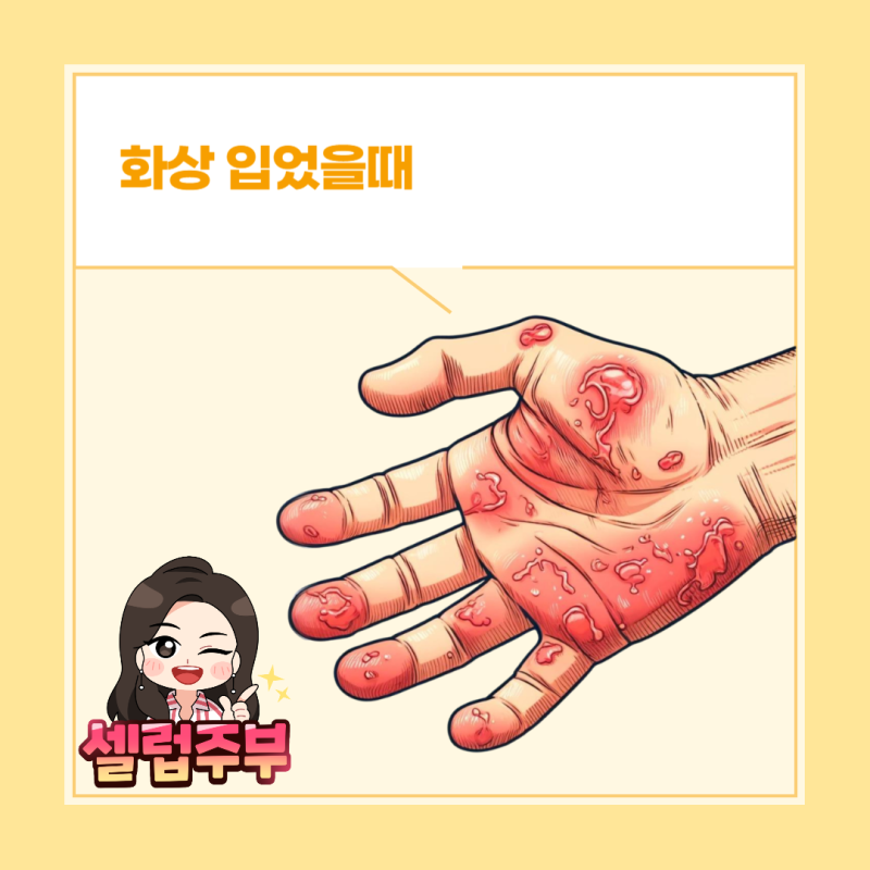 화상입었을때 1도 2도 3도 응급처치 방법 숙지 : 네이버 블로그