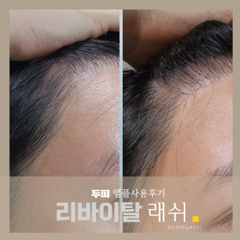 리바이탈래쉬 헤어 M자 정수리 한 달 사용 후기 볼륨 인핸싱 폼