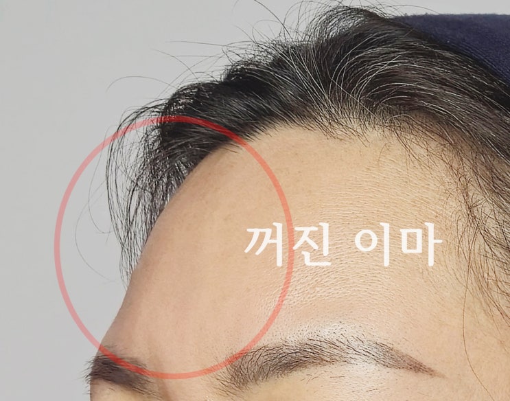  홍대 피부과 이마 앞볼 앞광대 필러 1차 후기