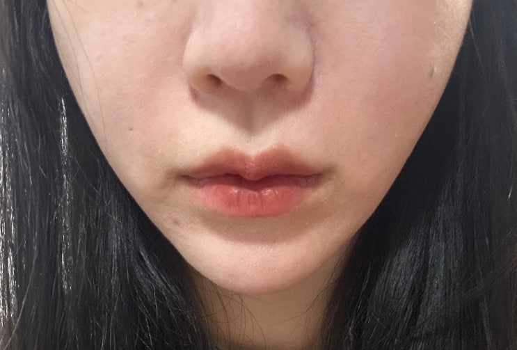  턱라인 효과본 강남실리프팅 2주차 후기 (가격, 붓기, 통증) 신사역 성형외과 당기지오