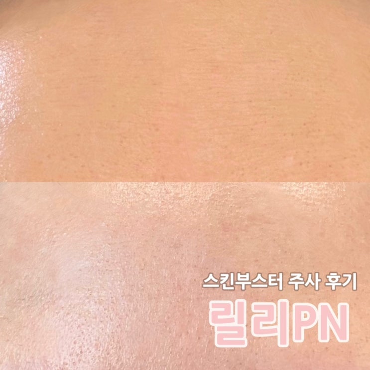  하단 피부과 스킨부스터 릴리PN 주사 2cc 속건조 후기