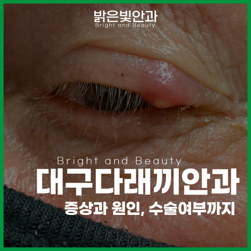 대구 다래끼안과 꼭 수술해야 할까요? 안과 전문의가 알려주는 병원 가야 하는 증상