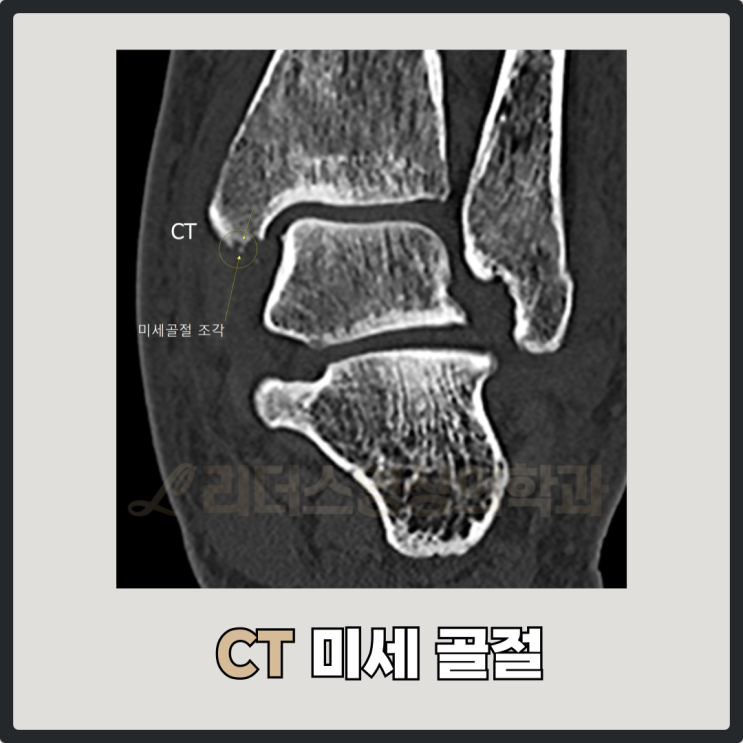  인천 발목 골절로 보는 CT와 MRI의 차이점