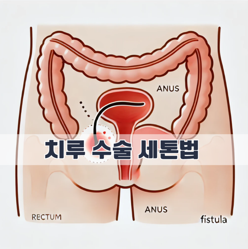 치루 수술 세톤법, 단계적 치료와 2차 수술의 전문적 이해