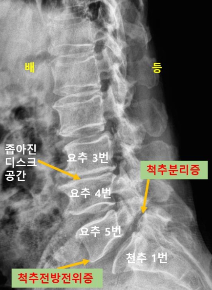  광주골반교정, 추간공협착증 수술 피한 case