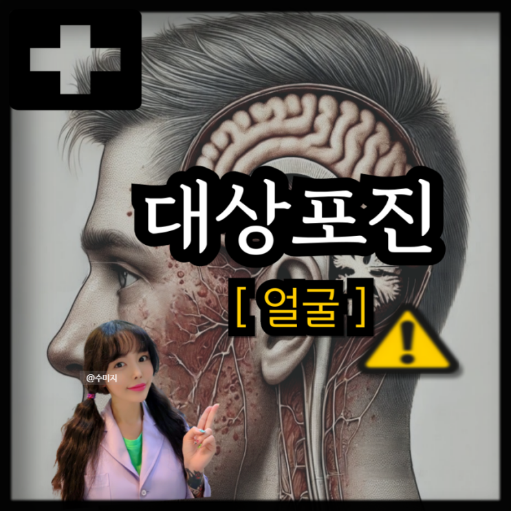 입돌아가는병 람세이헌트증후군 안면마비 구안와사 증상 치료