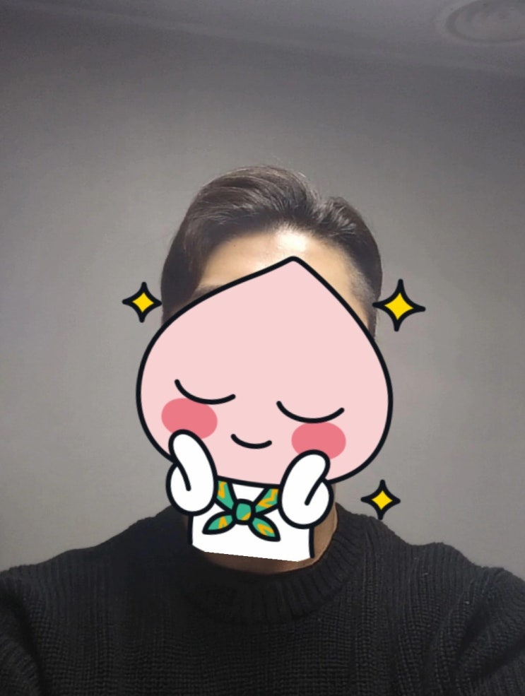  터키 모발이식 1년 8개월 후기입니다~