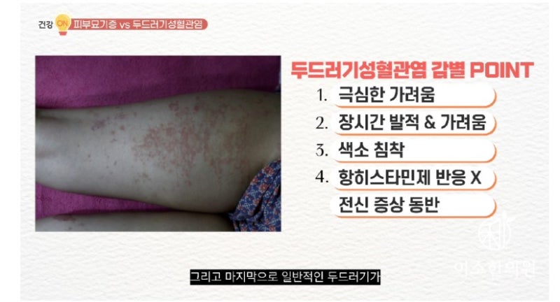 두드러기성혈관염, 피부과약을 먹어도 호전이 안되는 두드러기