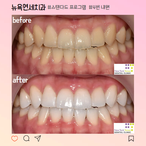  압구정치아미백 잘하는 곳 추천 전후 비교