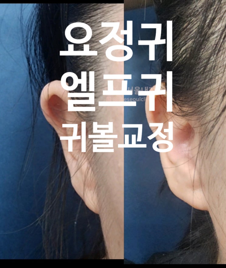  안산피부과 요정 엘프귀필러 통증 가격 효과 (아르네의원 원장 직접작성)