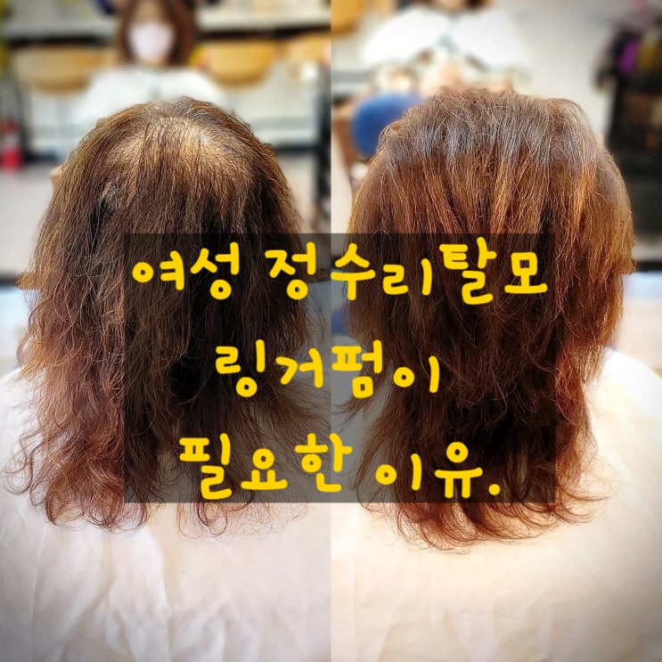  여자 정수리탈모, 자연스럽게 커버하는 링거펌 시술 후기 (광양미용실 미스터쏜)
