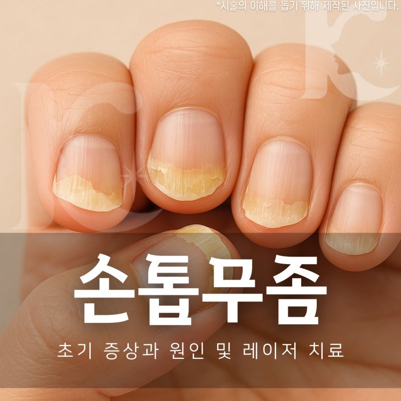 손톱무좀치료 초기증상과 레이저로 균을 없애야하는 이유
