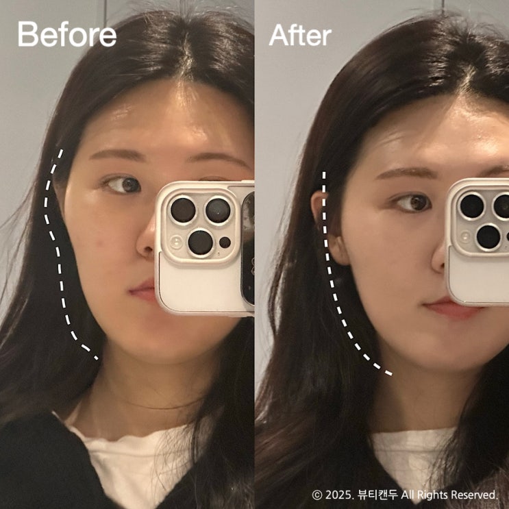 부천피부관리 땅콩형얼굴 개선 가인미가 부천상동역점 후기