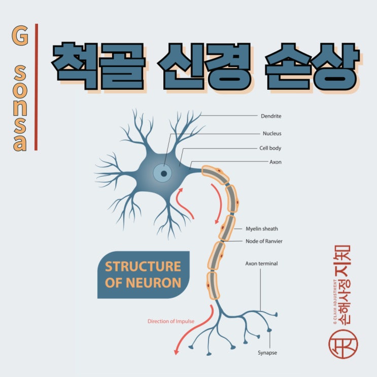  척골 신경 손상 : 새끼손가락 저림의 원인부터 재활 방법까지 - [상해정보, AlDa]