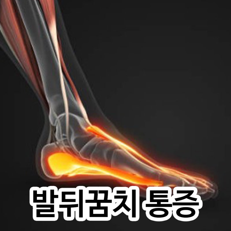 걸을때 발뒤꿈치 바깥쪽 통증 원인별 치료법 7가지