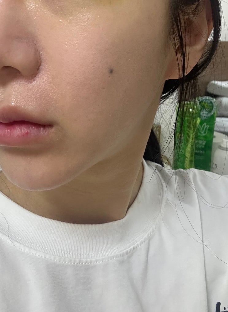  속건조 잡아주는 강남역 피부과 리쥬란 후기 2주차 (병원, 가격, 통증) 강남역 리쥬란 힐러 2cc