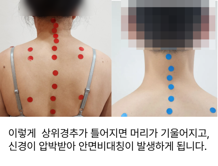  동래 사직동 안면비대칭, 턱관절 교정? 진짜 원인은 목틀어짐에 있습니다.