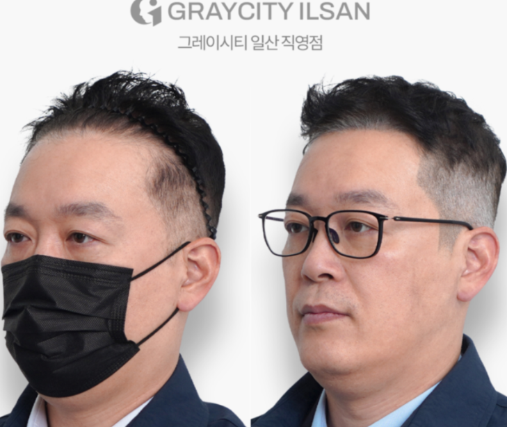 일산두피문신, 고민? 왜하시나요?
