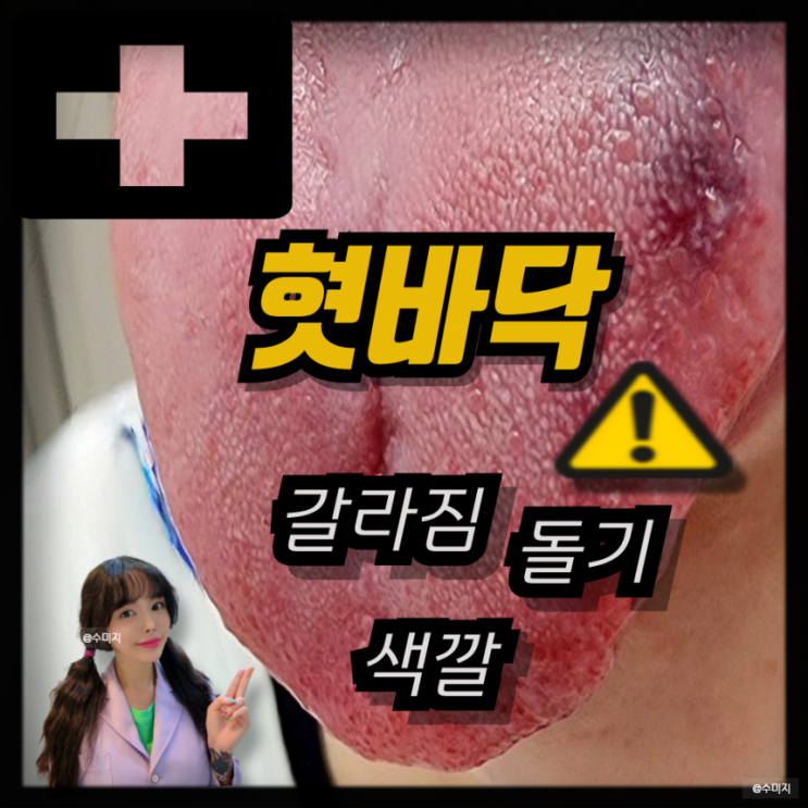  혓바닥 건강 혓바닥 갈라짐 돌기 색깔 지도상설 설유두 혀모양