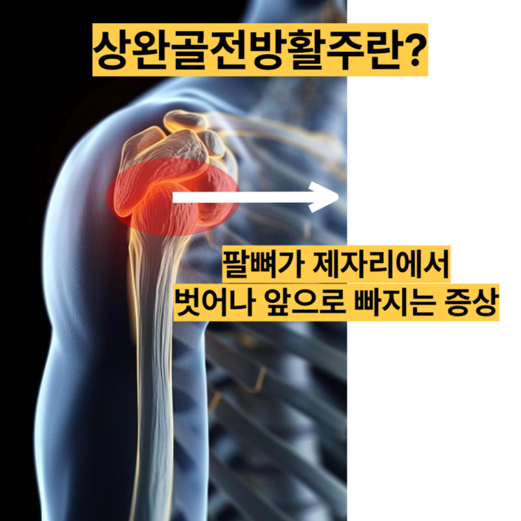  동래 사직동 상완골전방활주 교정, 어깨전방통증이 있으시다면?