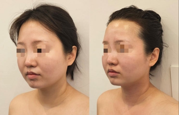  얼굴 골격의 무게중심을 끌어올리는 '지기상승 트리트먼트' 체험기