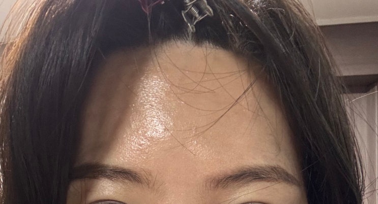 용산 한남동 피부과 오래된 이마 수두자국 흉터제거 치료 후기 용산 한남동 피부과 오래된 이마 수두자국 흉터제거 치료 후기