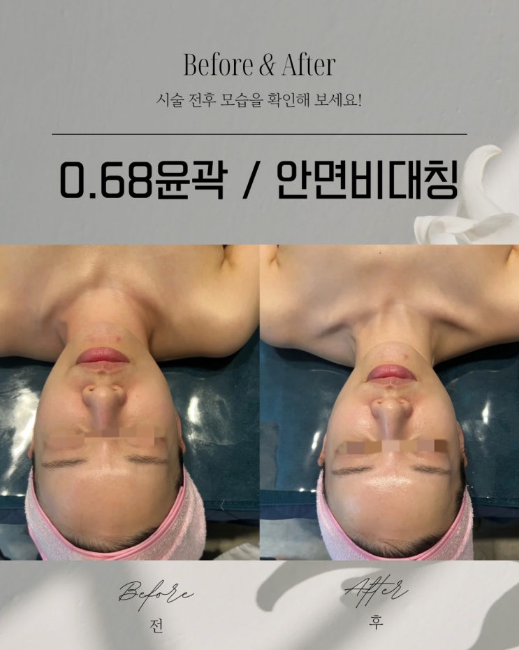  명륜동피부관리 안면비대칭 개선