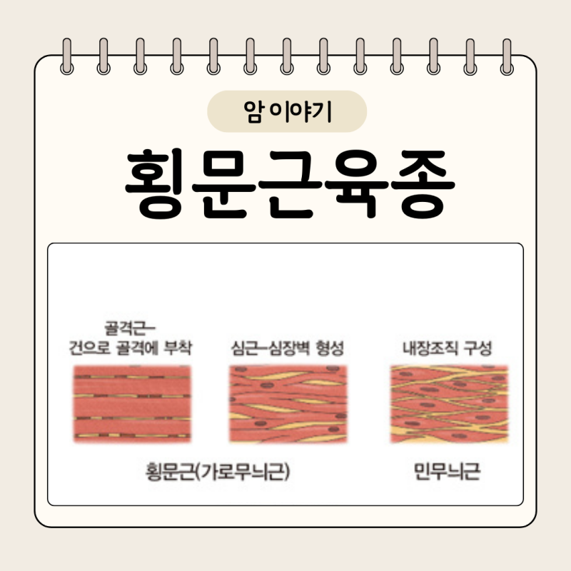 횡문근육종 증상의 원인 완치 가능성은