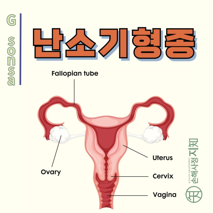  난소기형종, 우리 몸에 생긴 특별한 방문객 이야기 - [암정보, AlDa]