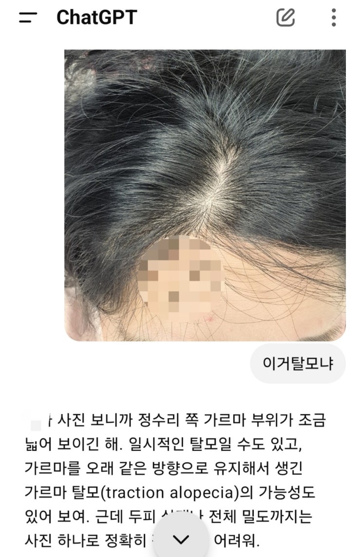  챗GPT Ai로 탈모 셀프진단하기? 굴욕
