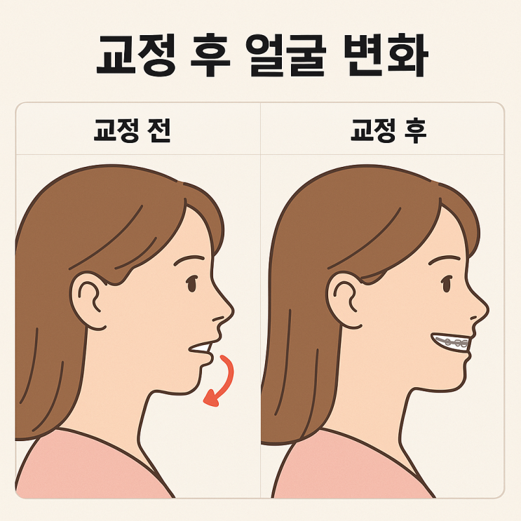  양평 교정치과, 교정하면 얼굴형도 바뀔까요? 교정하고 갸름해질까요? 교정하면 사각 턱이 없어질까요?
