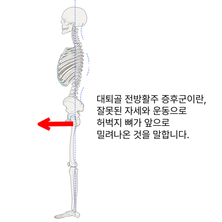  부산 동래 대퇴골전방활주, 고관절앞쪽과 허벅지통증이 있으시다면?