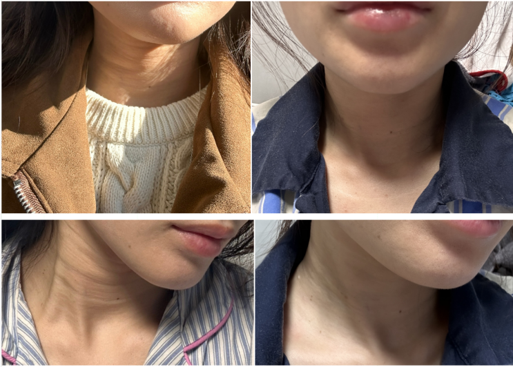  종로역피부과 목주름콜라겐주사 가로목주름 통증 경과 전후비교