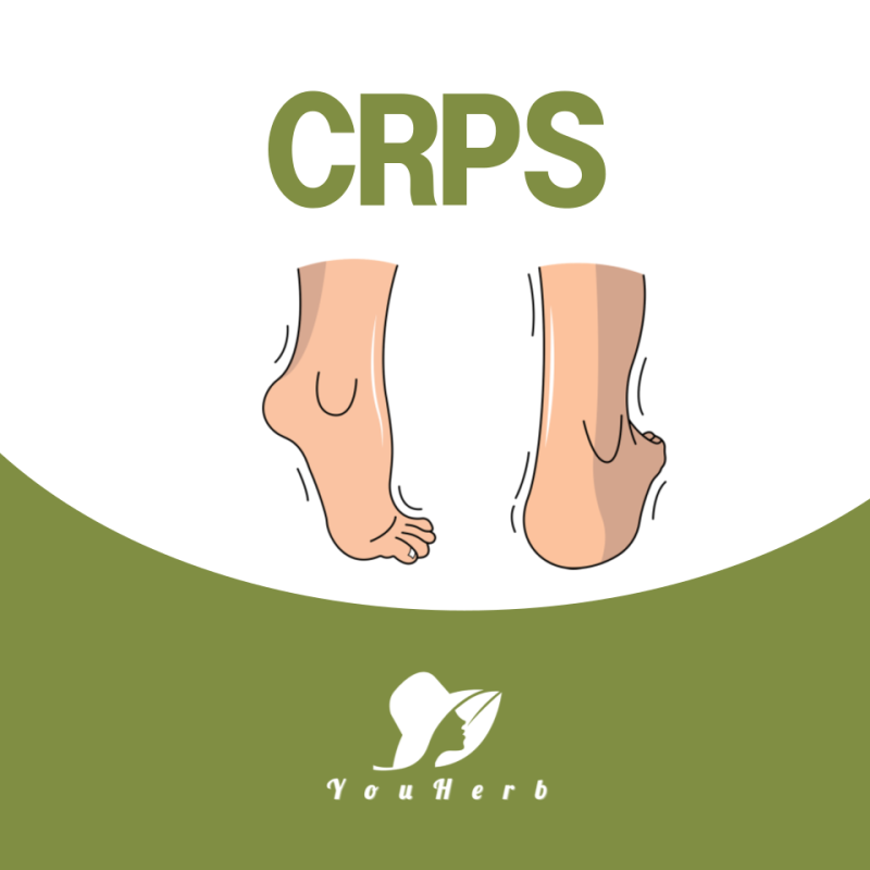 CRPS 뜻과 원인 증상 완치 확률 필독