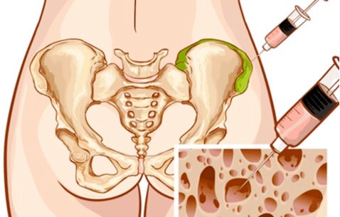 골수검사 bone marrow biopsy 통증 결과 후기 입원