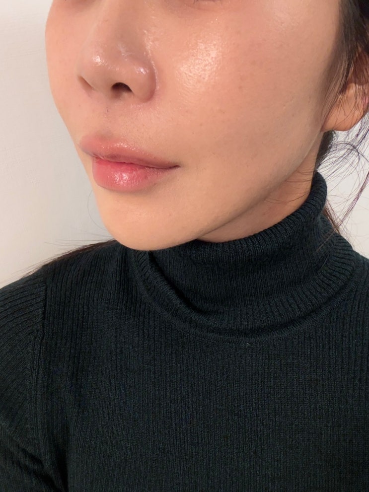  연신내피부과 벨로테로 물광주사 리바이브 스킨부스터 효과 통증 엠보 후기
