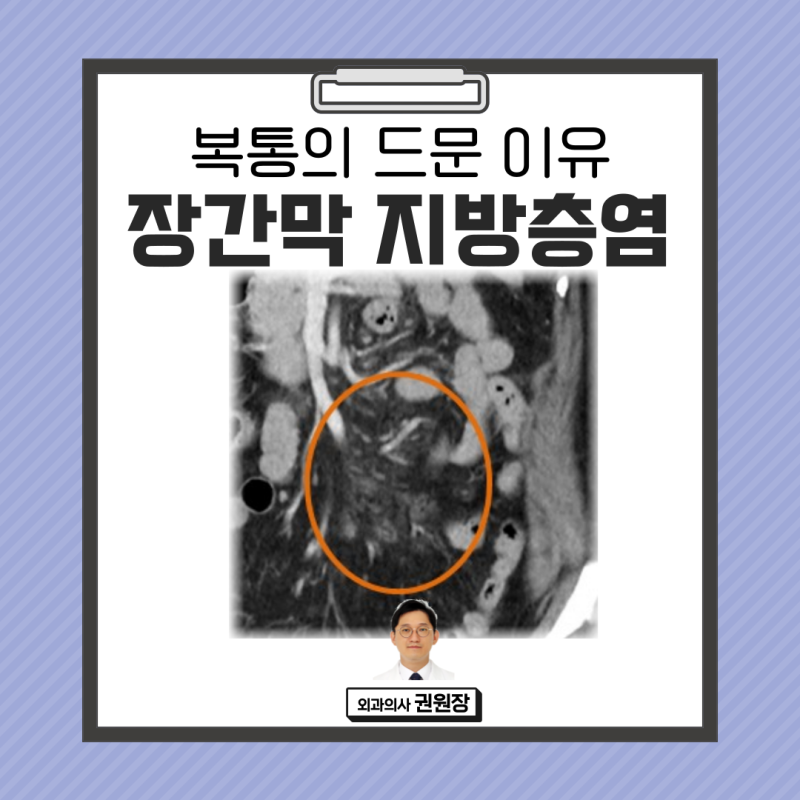 복통의 드문 이유 : 장간막 지방층염 (경화성 장간막염)