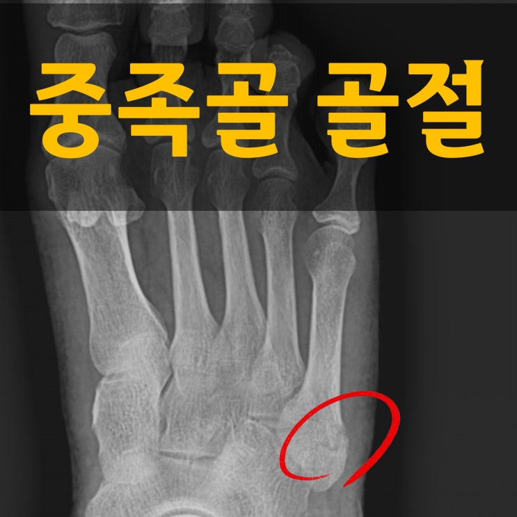  발등 골절 : 중족골 골절 증상 회복 식단 알려드립니다!