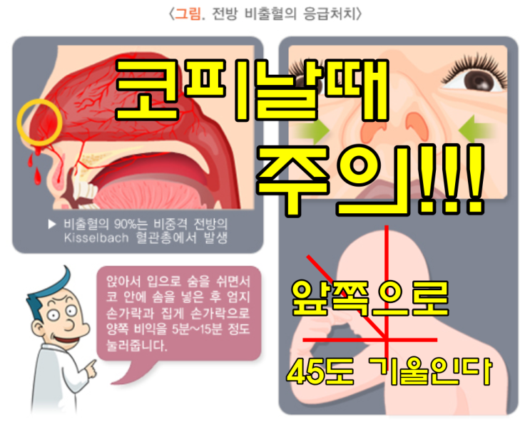  어린이 코피 예방법, 코피 응급처치법