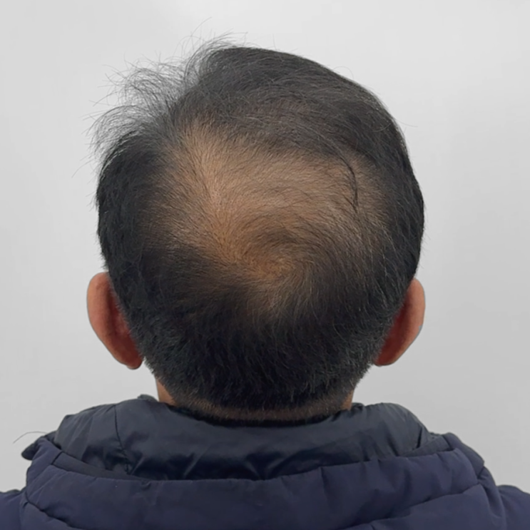  대전세종두피문신으로 탈모스트레스 해결