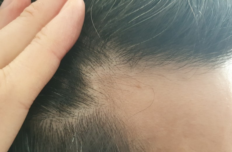 바이브랩 홍현희 두피앰플 M자 정수리 내돈내산 후기