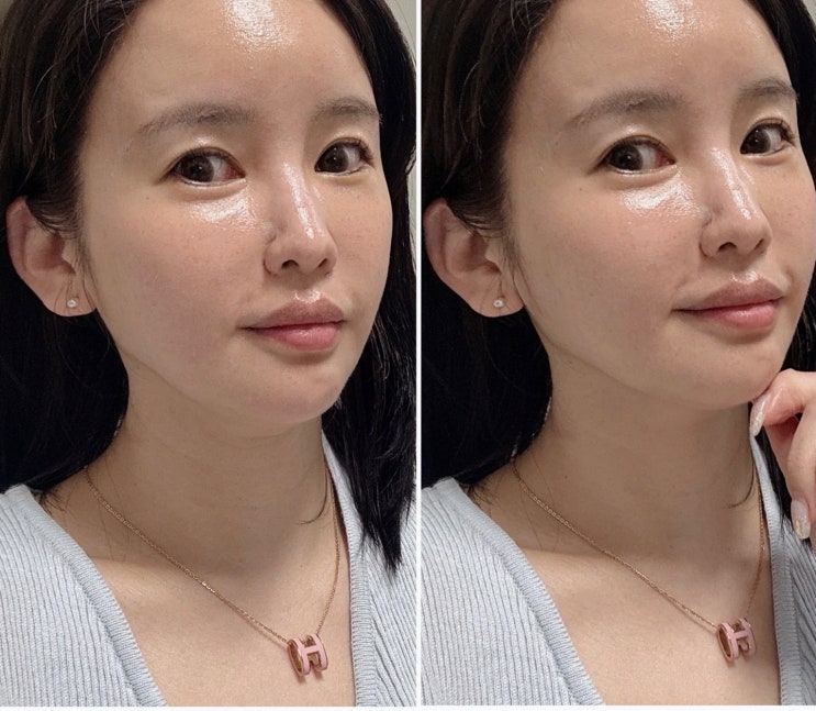 부산해운대피부과 천연 스킨부스터 콜라겐 컨택터 2차 후기 부산해운대피부과 천연 스킨부스터 콜라겐 컨택터 2차 후기