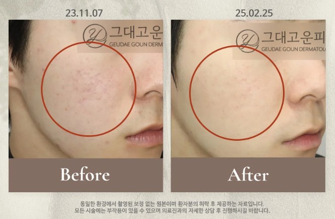 해운대 여드름흉터 시간 지나면 좋아진다고? 착각입니다. 해운대 여드름흉터 시간 지나면 좋아진다고? 착각입니다.