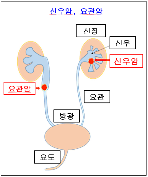 요관암 신우암