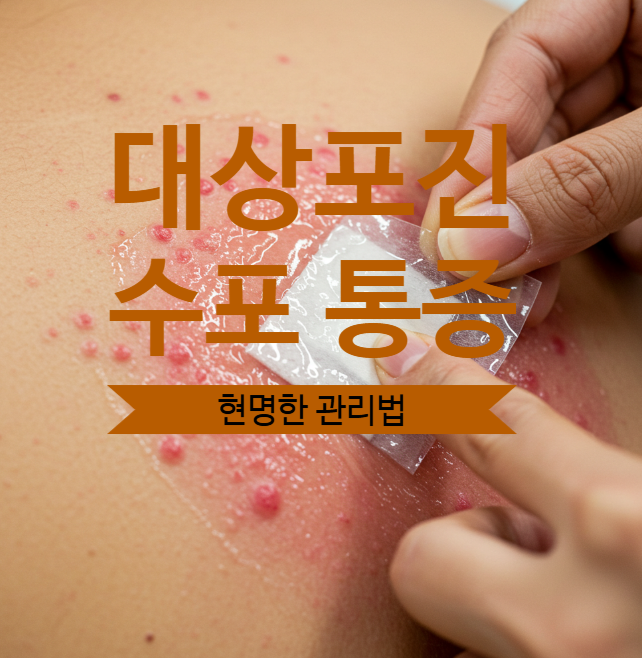  안산 대상포진 치료병원에서 통증 수포관리 추천 (의사 직접작성, 의학지식전달)
