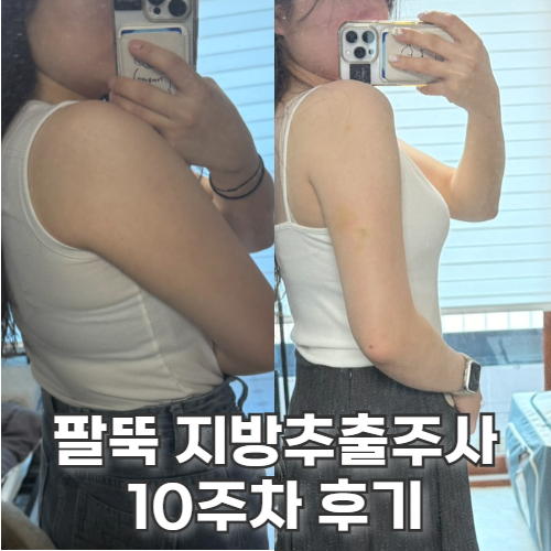  교대역 지방추출주사 팔뚝 10주 효과 ~ 경과 찐후기