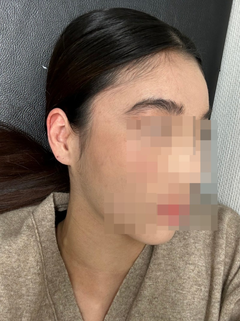 [탈모 앰플 리뷰] 리바이탈 래쉬 볼륨 인핸싱 폼 3통 사용 후기(2년 넘게 써보면서 느낀 점, 부....