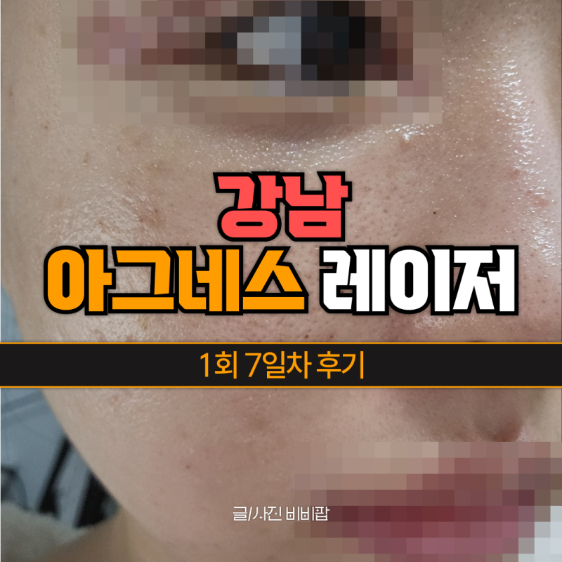 ✨강남 아그네스 레이저 1회✨ 7일차 후기 :: 30대 일반인 여드름 피부 관리 내돈내산 레이저 1....