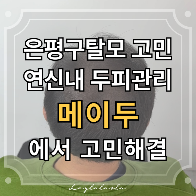  은평구탈모 고민된다면, 연신내두피관리 메이두에서 케어 받아보세요